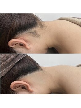 ミース 北九州店/うなじ脱毛◆ビフォーアフター