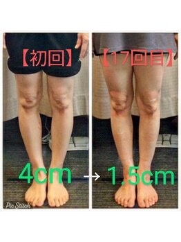 クシロ鍼灸整骨院/【O脚矯正】施術例