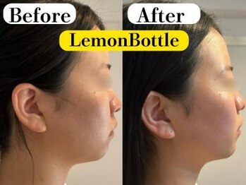 ビースキン 広島(BE:SKIN)/レモンボトル/顎たるみ