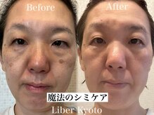 リベルキョウト 京都駅前店(Liber Kyoto)/魔法のシミケア