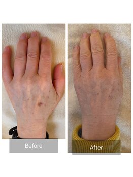 エメ(Aimer)/【70代手のシミ結果写真☆】