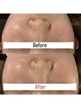 ハイコガオ 中崎町店(HIKOGAO)/ララピール