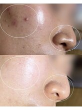 ソワ 吉塚店(soi)/自分の肌を見て涙することも。