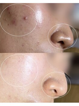 ソワ 吉塚店(soi)/自分の肌を見て涙することも。