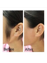 アイリス(AIRIS)/もみあげWAX脱毛