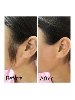 アイリス(AIRIS)/もみあげWAX脱毛