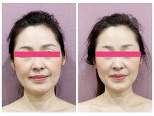 アゴラ/【小顔】豊富な施術実績有り