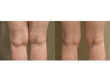 エス シークレット 金町店(S secret)/60代も美脚に若々しく！セル脂肪