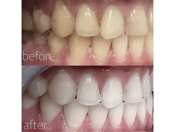 ハリス(HARIS)/セルフホワイトニング