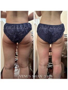 リアン 南熊本店(Lien)/毛穴改善・痩身・ダイエット