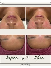 メイ(meiy)/小顔/美白/毛穴/フェイシャル