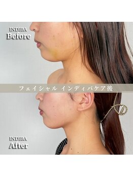 術後の女神 大阪心斎橋店/術後ケアインディバ・インディバ