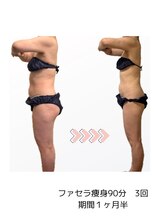 コーラル(Coral)/ファセラボディ（50代施術結果）