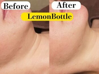 ビースキン 広島(BE:SKIN)/レモンボトル/顎たるみ