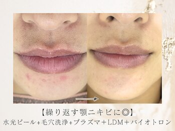 アネラボーテ(Anela Beaute)/ニキビ改善コース3回目