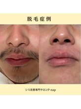 ピーナップ(P-nap)/髭脱毛