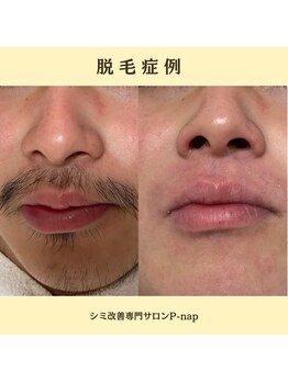 ピーナップ(P-nap)/髭脱毛