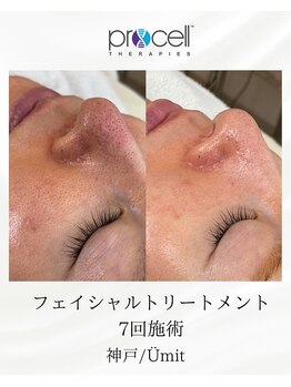 ユミト(Umit)/プロセルフェイシャル