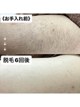 ミノア 大野城店(MINOA)/メンズ脱毛6回ビフォ‐アフタ‐