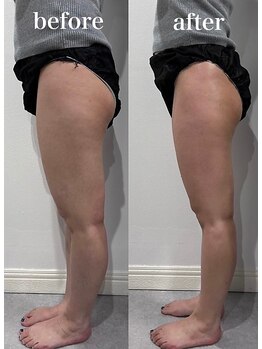 テンディ(TenD.)/パーソナルリンパケア