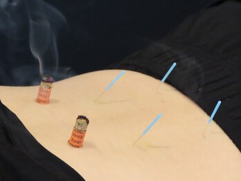 自分メンテ/鍼灸施術