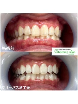 ホワイトニングサロン 名古屋駅店/【ホワイトニング施術例】