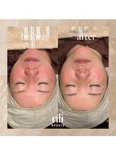 ウリ(uli beauty)/比較写真