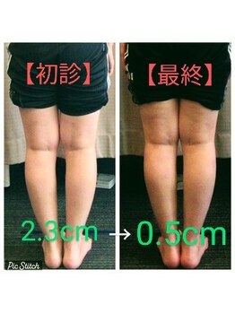 クシロ鍼灸整骨院/【O脚矯正】施術例