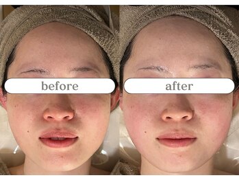 リスタ(RSTA)/【BEFORE/AFTER】