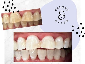 ホワイト つくば店(WHITE)/BeforeAfter(プラチナコース)