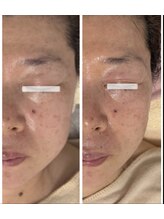 クールグラシュー(couer gracieux)/#リフトアップ効果