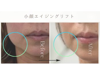 シルキーエービューティー(Silky A Beauty)/小顔エイジングリフト