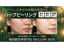 メロウスキン(MELLOW SKIN)の雰囲気(敏感肌もOK!剥かないピーリング)