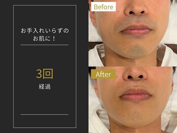 ステイゴールド 新百合ヶ丘(STAY GOLD)/おヒゲ脱毛の経過☆