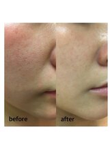 ル ミュー(le mieux)/REVI陶肌トリートメント