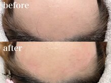 アミュゼ(Amuser)/おでこワックス