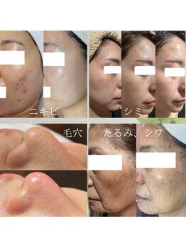 由縁/肌質改善プログラム