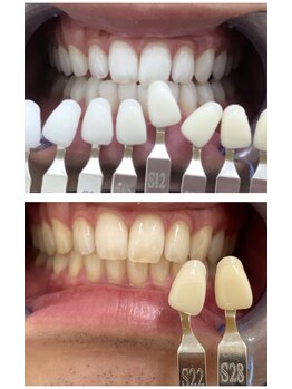 エクシアホワイトニング 日本橋店/ビフォアフ