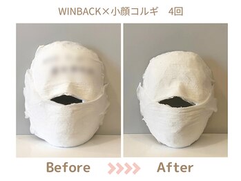 リトリト(Retreat)/小顔コルギ4回目ビフォアフター