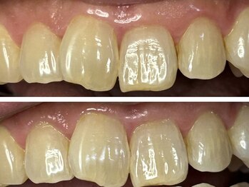 コハク(kohaku)/衛生面重視セルフホワイトニング