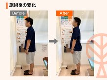 ただき接骨院 整体院 新前橋院/施術後の変化：猫背・巻き肩