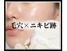 無料相談｜ニキビ・毛穴開き・凸凹・毛穴でお悩みの方に◎肌トラブル改善
