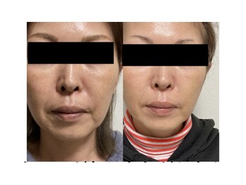 ビーエフジー(B F G)/強力リフティングで理想の小顔に