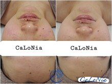 カロニア(CaLoNia)/敏感肌・トラブル肌を改善！