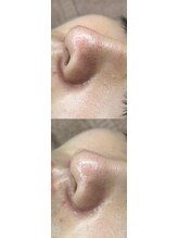 サロン ハリー(SALON HARRY)/韓国肌管理ララピールLHALA