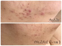 シェミー(CHEZ MEE)/繰り返すニキビケア/肌質改善