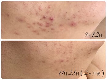 シェミー(CHEZ MEE)/繰り返すニキビケア/肌質改善