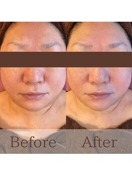 凪眠/小顔リンパフェイシャルの効果7