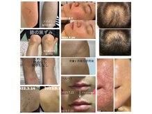 リアンジェ(Lianje)の雰囲気（アズイルスの効果、症例あり。ヘアメイクさんも愛用されてます）