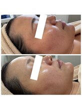 ココリル(cocorire)/ULDM×白玉酸素セラピー